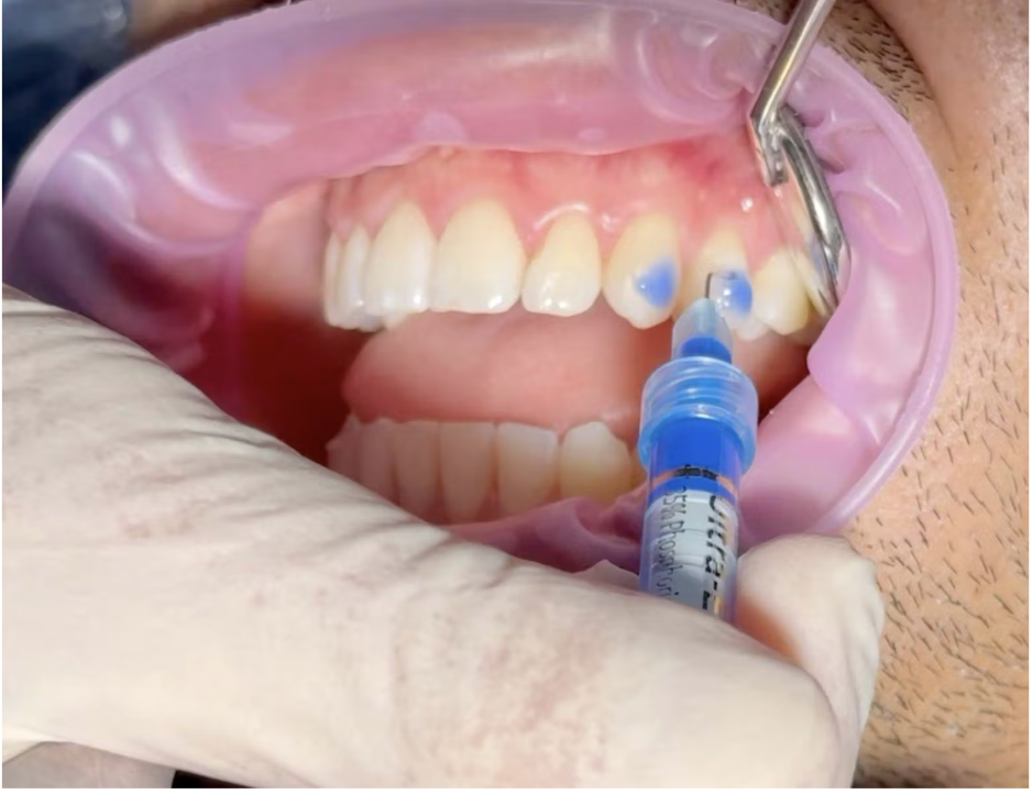 Vì sao attachment quyết định thành công trong điều trị bằng khay trong suốt?